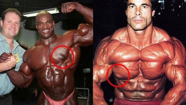 Bodybuilders with Gyno